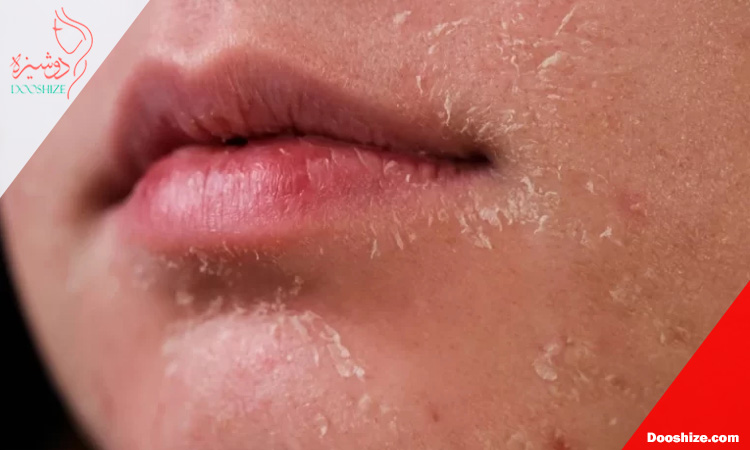 علت پوستهپوسته شدن پوست بعد از لایهبرداری چیست؟