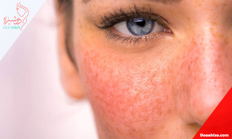 چرا پوست پس از لایه برداری دچار قرمزی و التهاب می شود؟
