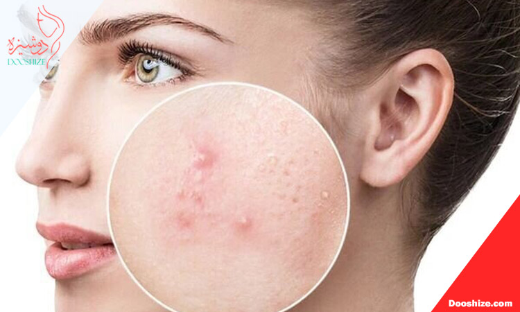 تصور اشتباه «طبیعی بودن» و رابطه آن با جوش زدن پوست