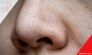 چرا بعد از پاک سازی پوست هنوز جوش سرسیاه داریم؟ نکات علمی و عملی