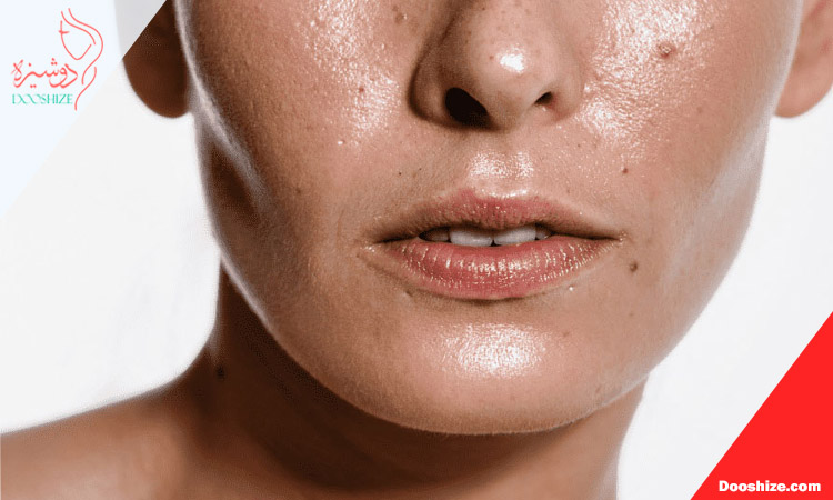 چرا در تابستان چربی پوست افزایش می یابد؟ نگاه علمی به عملکرد غدد سباسه